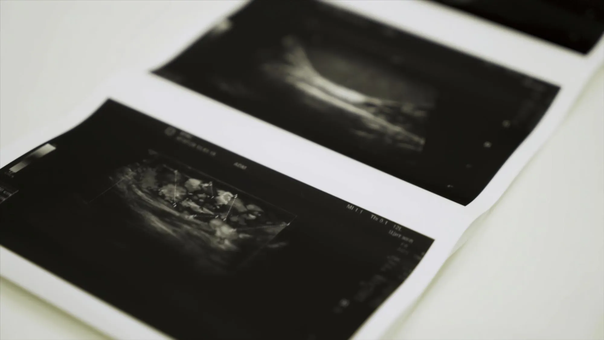 Collection of images from ultrasound scan examination action close up of monochrome images of