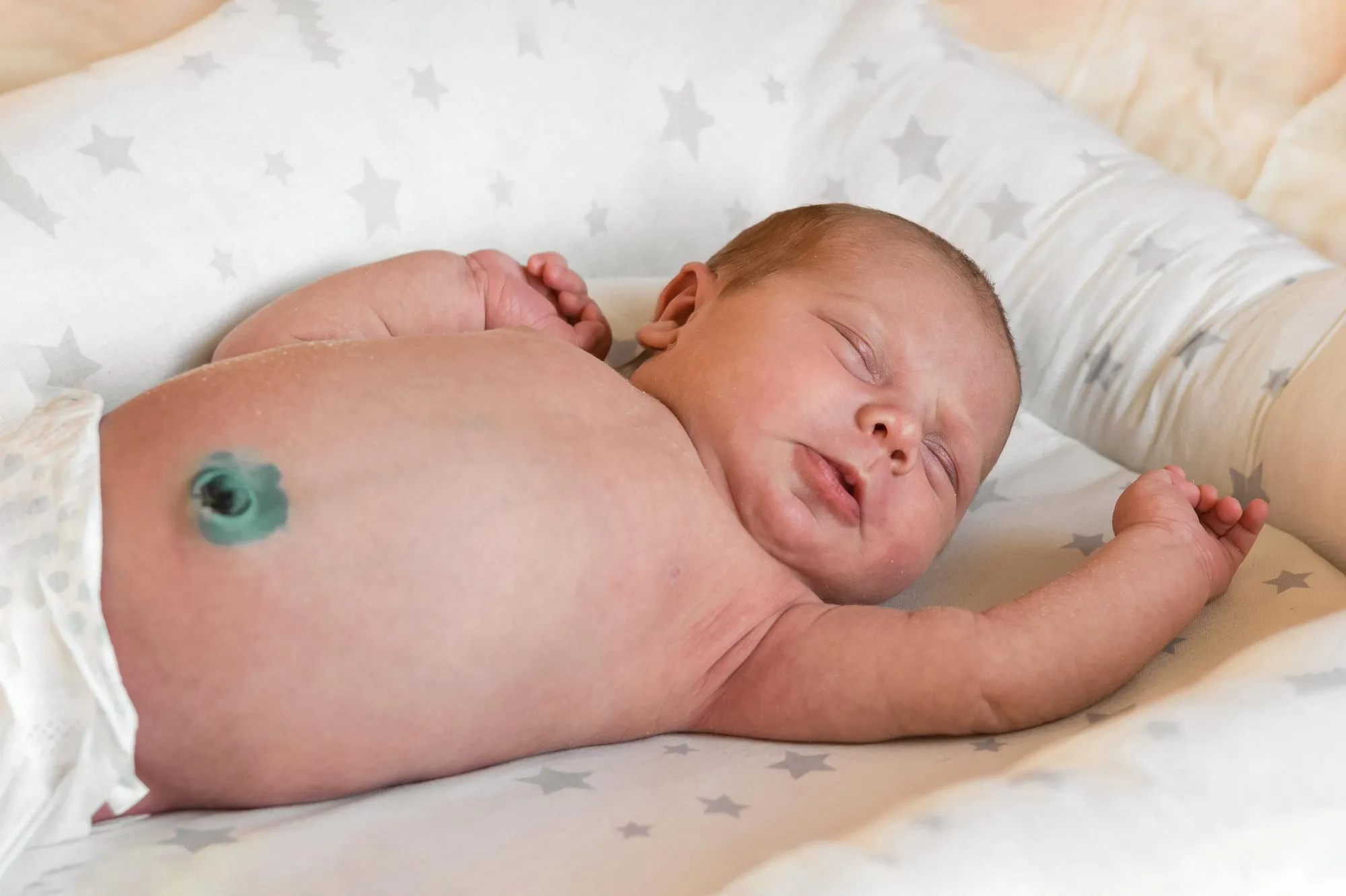 Newborn baby with unhealed navel treatment umbilical cord treated antiseptic infant lying