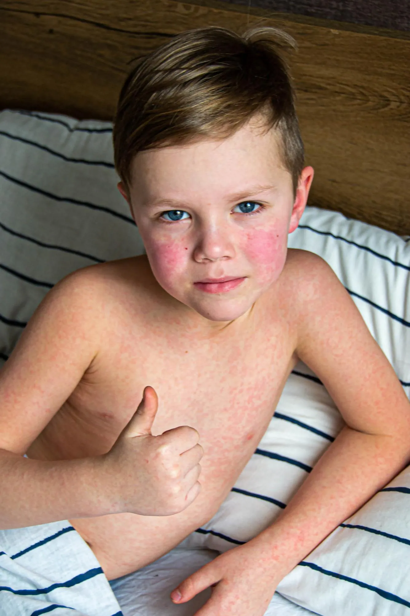 Viral disease Measles rash on the body of the child Allergy