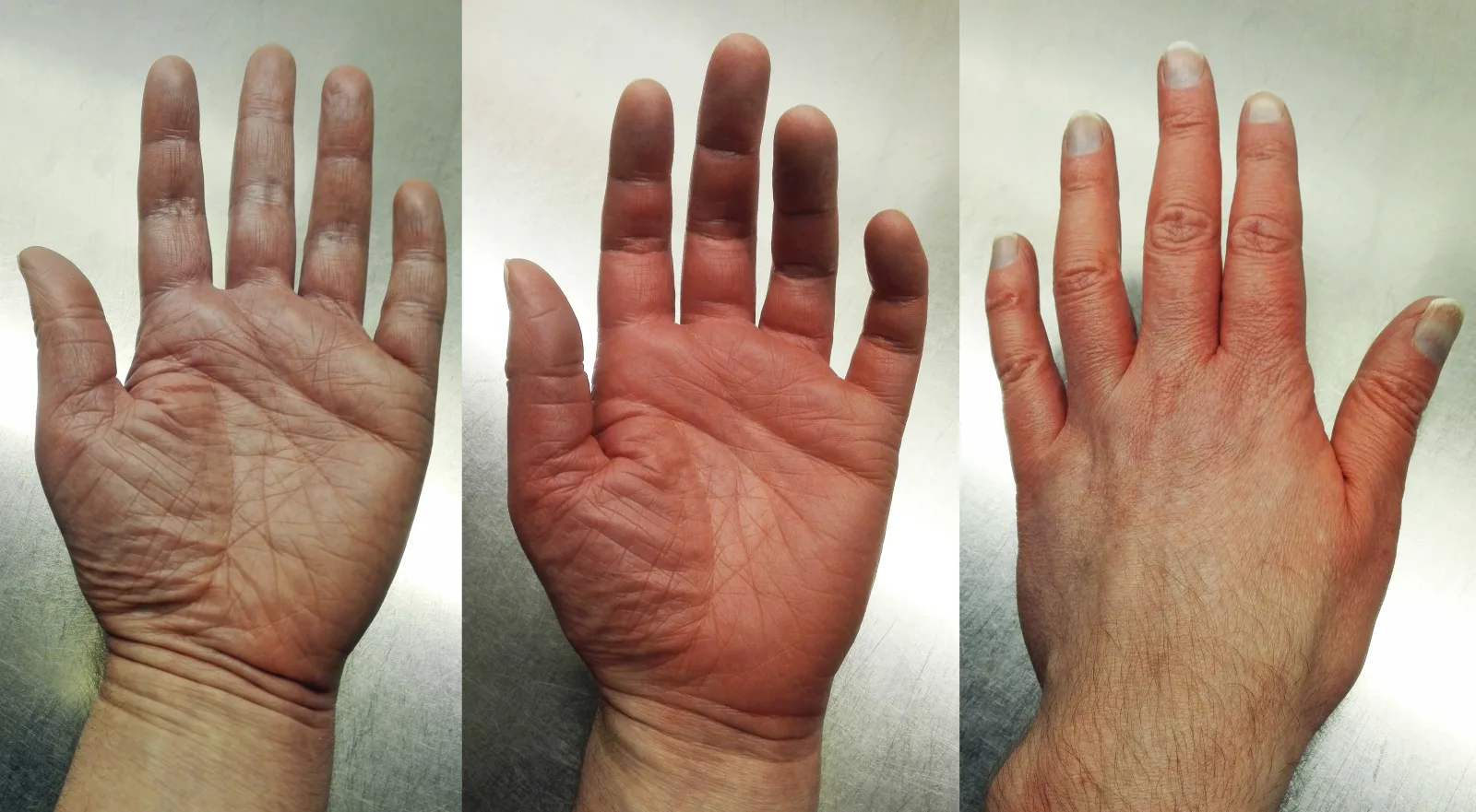 Erythromelalgia in left hand of Scandinavian male, 53, with hereditary small-fiber neuropathy and erythromelalgia in feet, hands and ears. To the left: Palm just before an erythromelalgia "flare-up", skin becoming mottled and a cold pain setting in. In the middle: Palm during a flare-up, with hyperemia also in most parts of fingers. Hand hot with severe burning pain. To the right: Back of hand during flare-up. Skin itching with a painful tingling sensation. Nails grey with a blue tint in lunulae (typical for this patient), indicating hypoxia due to vasoconstriction in spite of the hyperemia.